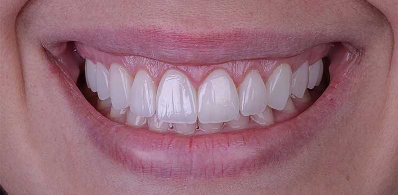 After Hollywood Smile