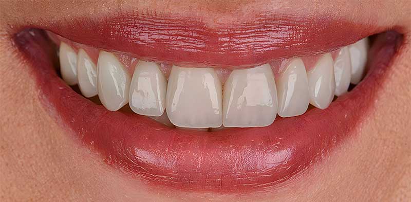 After Hollywood Smile