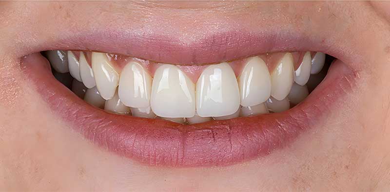 After Hollywood Smile