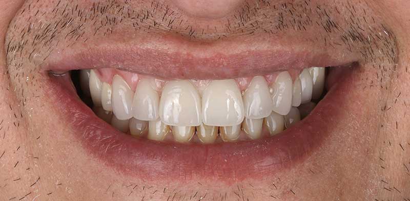 After Hollywood Smile