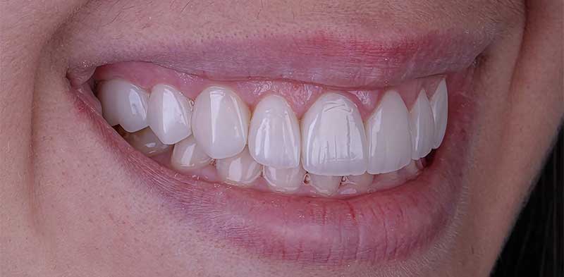 After Hollywood Smile