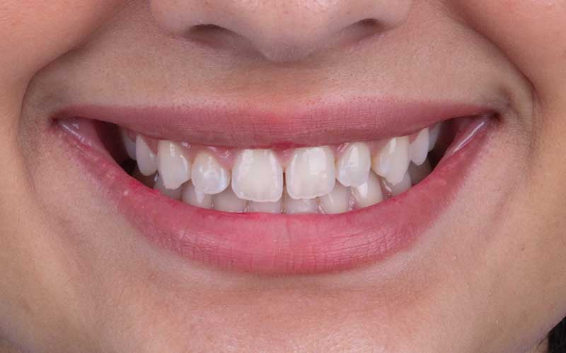 Before Hollywood Smile Makeover
