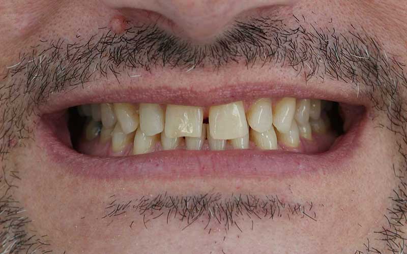 Before Hollywood Smile Makeover