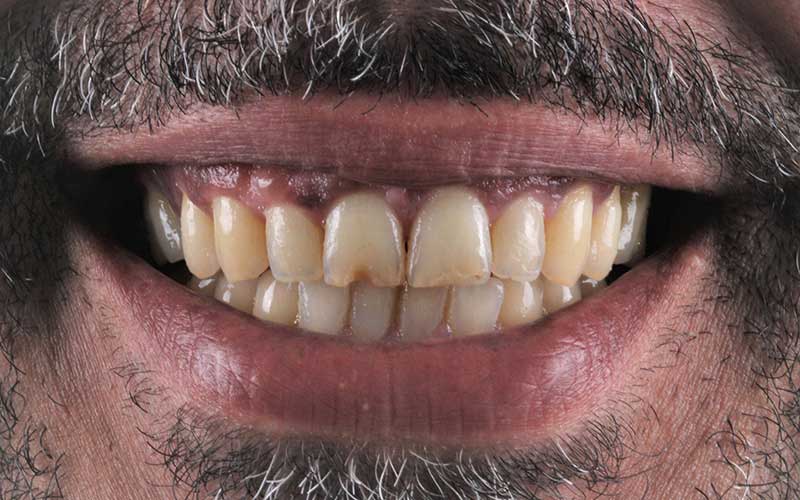 Before Hollywood Smile Makeover