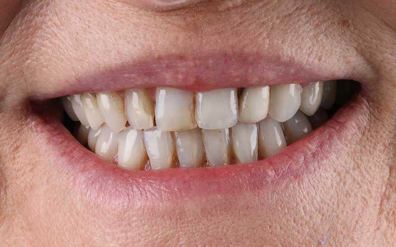 Before Hollywood Smile Makeover