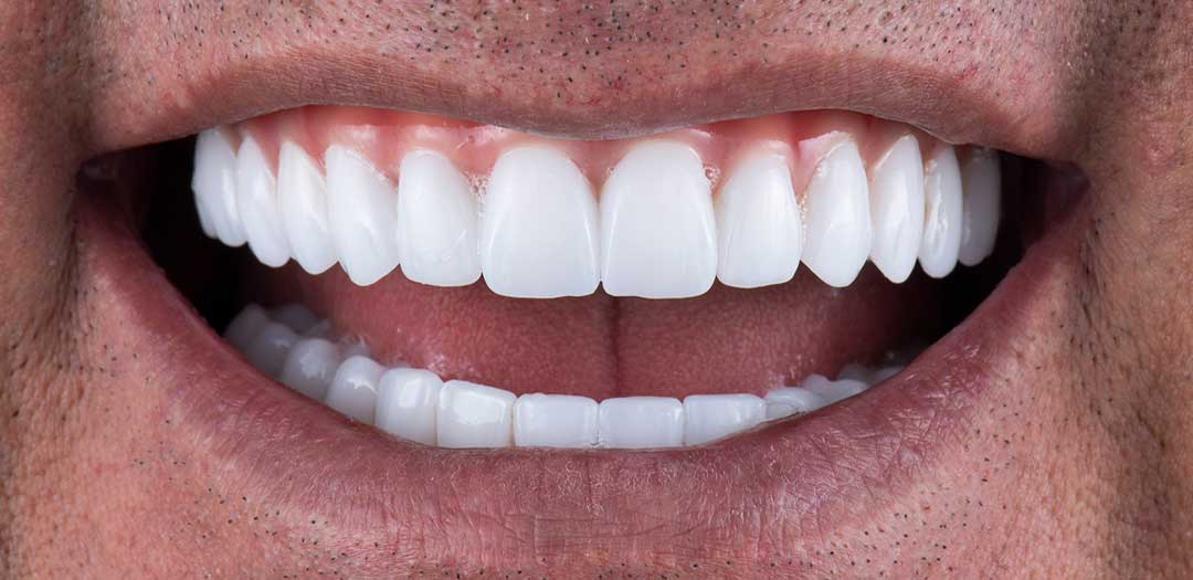 Full Mouth Dental Implants in Dubai