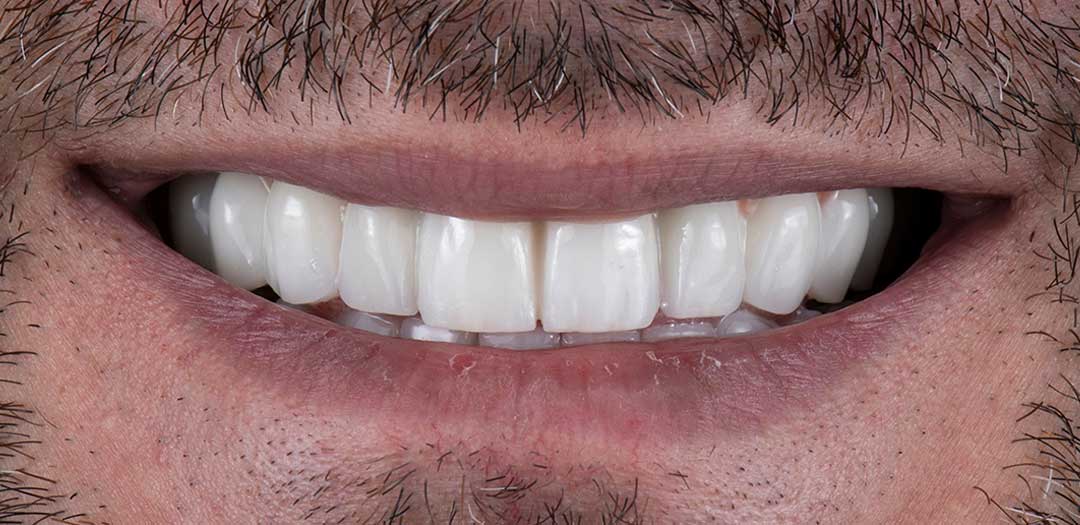 Full Mouth Teeth Implants in Dubai