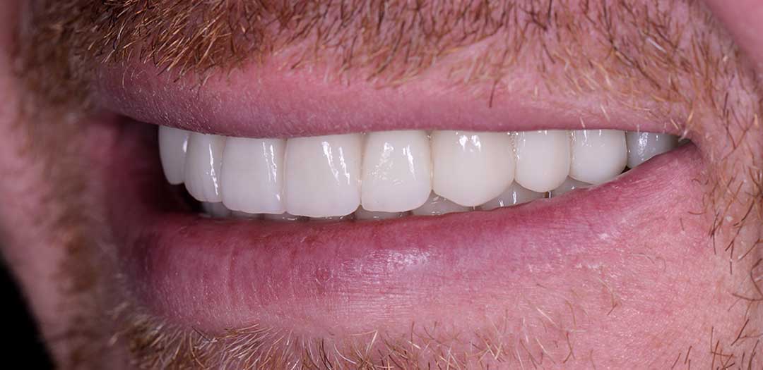 Full Mouth Teeth Implants in Dubai