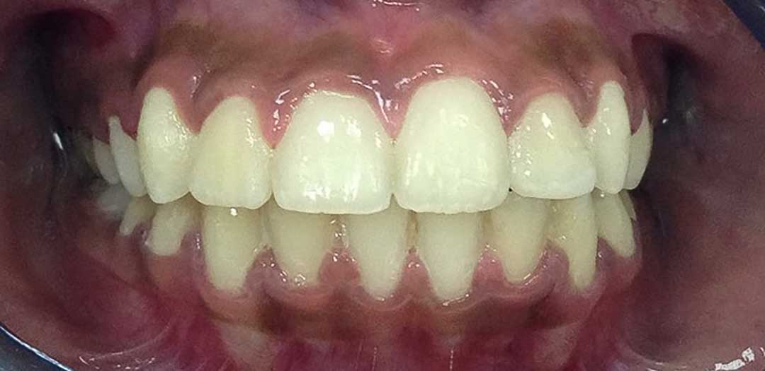 Dental Braces in Dubai