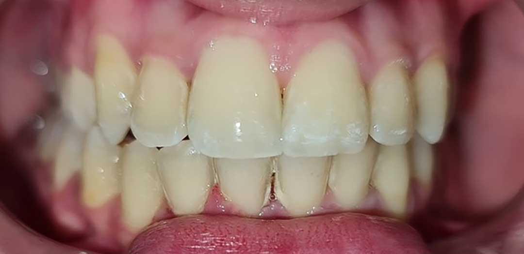 Teeth Braces in Dubai