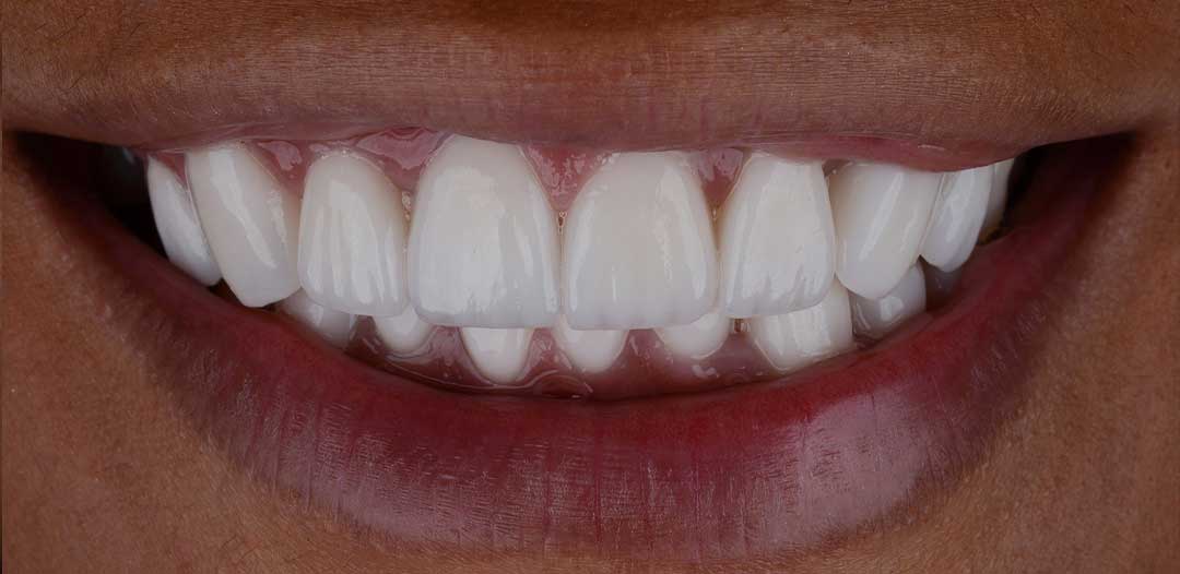 Porcelain Veneers
