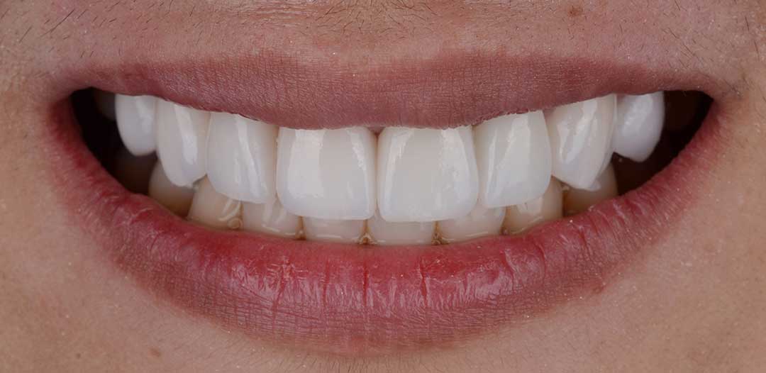 Porcelain Veneers