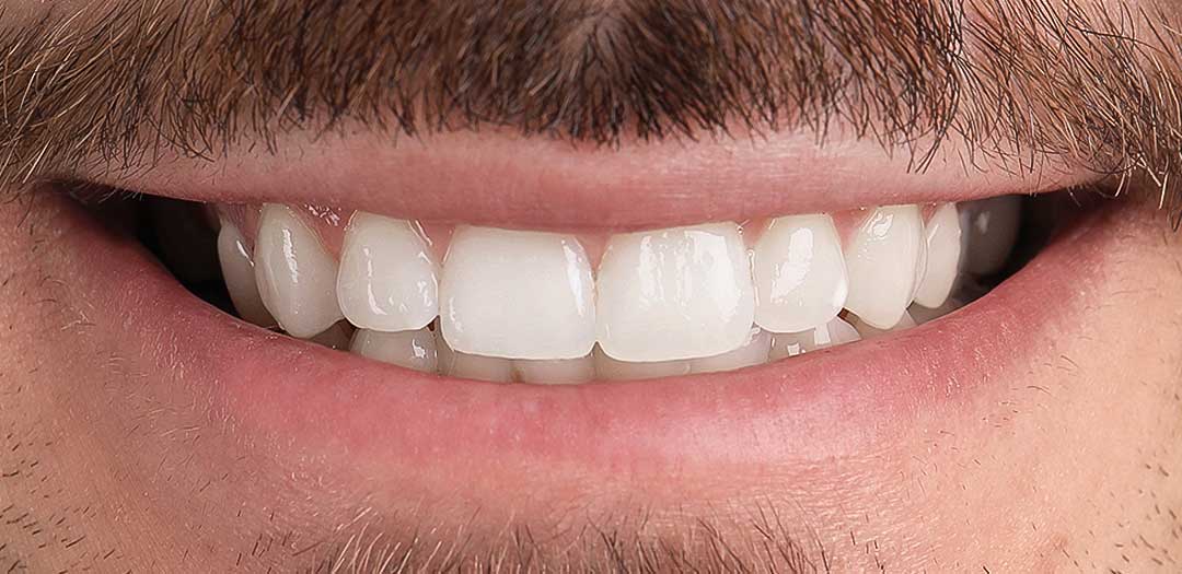 Teeth Whitening Dubai