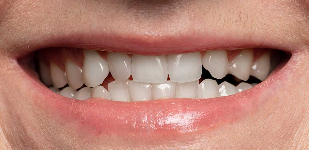 Teeth Whitening Dubai